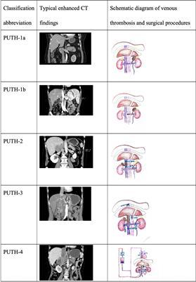 Clinical Experience and Management Strategy of Retroperitoneal Tumor With Venous Tumor Thrombus Involvement